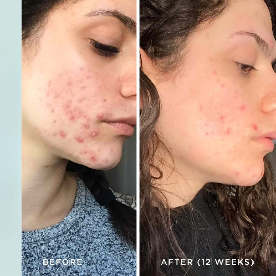 Acnevia – Advanced Acne Therapy